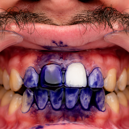 MOVREE V34 - Teeth Whitening
