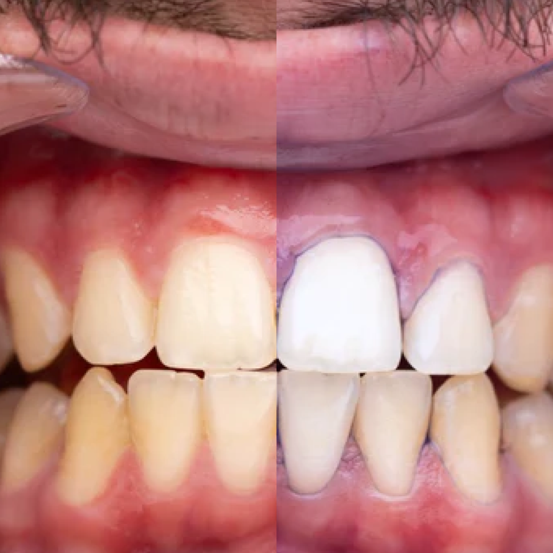 MOVREE V34 - Teeth Whitening